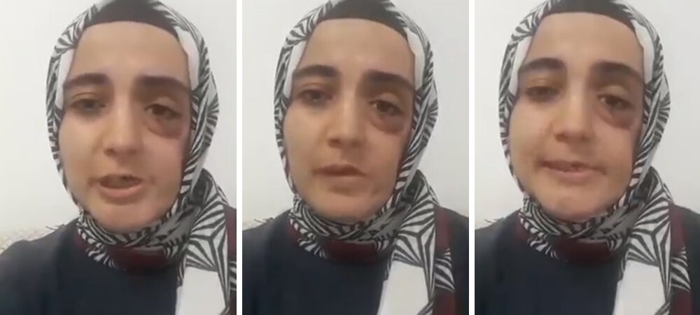 Ayşe Özdoğan’ın durumu kötüye gidiyor, yüzündeki platin yeniden çıkartılacak
