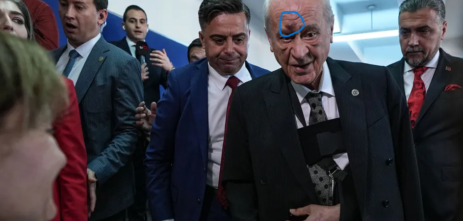 Günler sonra oy kullanmak için ortaya çıkan Bahçeli’nin yüzündeki morluklar dikkat çekti